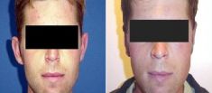 Ear surgery (Otoplasty) - Photo before - Dr. Dobos Calin