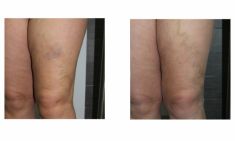 Sclerotization of varicose veins - Photo before - ARS ESTETICA – Klinika Medycyny Estetycznej i Laseroterapii