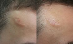 Scar removal - Photo before - ARS ESTETICA – Klinika Medycyny Estetycznej i Laseroterapii
