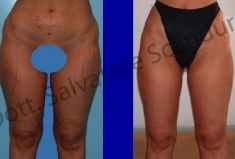 Liposuzione - Foto del prima - Dott. Salvatore Scandura M.D.