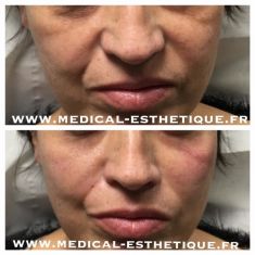 Injections de comblement - Cliché avant - Dr AMAT - ????Greffe FUE 2.0 Medic Xpert