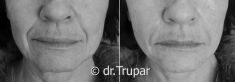 Injekční výplně - fotka před - MUDr. Evžen Trupar Ph.D.