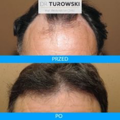 Hair Transplant - Photo before - Dr Turowski Hair Restoration Clinic