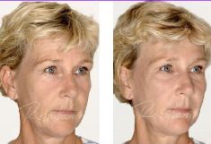 Hyaluronic acid-based wrinkle fillers - Photo before - Dr. Dobos Calin