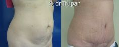 Abdominoplastika (Operace břicha) - fotka před - MUDr. Evžen Trupar Ph.D.