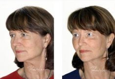 Hyaluronic acid-based wrinkle fillers - Photo before - Dr. Dobos Calin