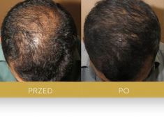 Hair Transplant - Photo before - Dr Turowski Hair Restoration Clinic