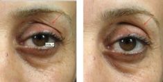 Radiofrequency Rejuvenation (Aluma, accent, TriPollar, Spa RF device, Re-Age) - Photo before - Klinika Laser Esthetic