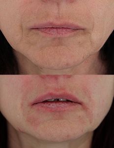 Injekční výplně - fotka před - MUDr. Evžen Trupar Ph.D.