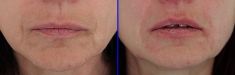 Injekční výplně - fotka před - MUDr. Evžen Trupar Ph.D.