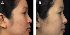 Fractional Laser Resurfacing - Photo before - Bieńkowscy Clinic®
