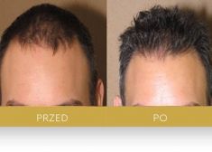 Hair Transplant - Photo before - Dr Turowski Hair Restoration Clinic