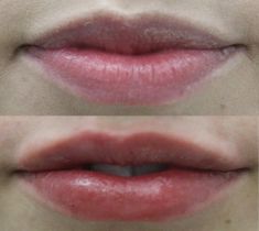 Lip augmentation - cheiloplasty - Photo before - ARS ESTETICA – Klinika Medycyny Estetycznej i Laseroterapii