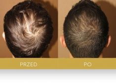 Hair Transplant - Photo before - Dr Turowski Hair Restoration Clinic