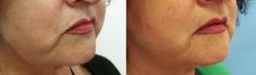 Injekční výplně - fotka před - MUDr. Evžen Trupar Ph.D.