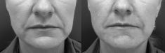 Injekční výplně - fotka před - MUDr. Evžen Trupar Ph.D.