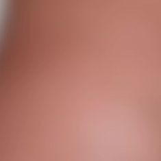 Breast Augmentation - Breast Implants - Photo before - Klinika Laser Esthetic
