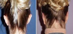 Ear surgery (Otoplasty) - Photo before - Dr. Dobos Calin