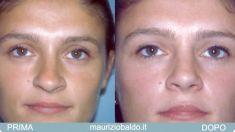 Rinoplastica - Foto del prima - Dott. Maurizio Baldo M.D.