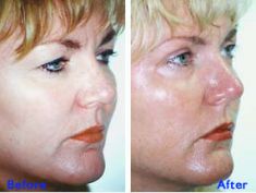 Eyelid surgery (Blepharoplasty) - Photo before - Azim Jahangir Khan M.D.