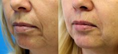 Injekční výplně - fotka před - MUDr. Evžen Trupar Ph.D.
