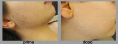 Procedure laser in dermatologia estetica - Foto del prima - Dott. Luca Leva Chirurgo Plastico