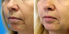 Injekční výplně - fotka před - MUDr. Evžen Trupar Ph.D.