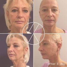 Neck lift - Photo before - MUDr. Lucie Kalinová PhD.