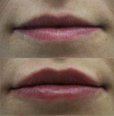 Lip augmentation - cheiloplasty - Photo before - ARS ESTETICA – Klinika Medycyny Estetycznej i Laseroterapii