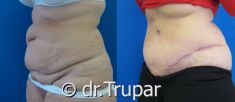 Abdominoplastika (Operace břicha) - fotka před - MUDr. Evžen Trupar Ph.D.