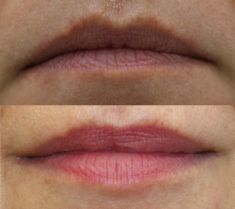 Lip augmentation - cheiloplasty - Photo before - ARS ESTETICA – Klinika Medycyny Estetycznej i Laseroterapii