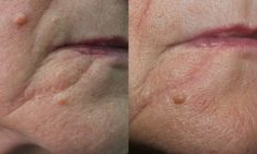 Scar removal - Photo before - ARS ESTETICA – Klinika Medycyny Estetycznej i Laseroterapii