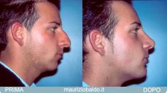 Profiloplastica (Rinoplastica e Mentoplastica) - Foto del prima - Dott. Maurizio Baldo M.D.