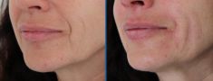 Injekční výplně - fotka před - MUDr. Evžen Trupar Ph.D.