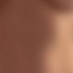 Radiofrequency Rejuvenation (Aluma, accent, TriPollar, Spa RF device, Re-Age) - Photo before - Klinika Laser Esthetic