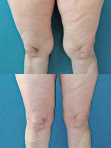 Liposukcia tumescenčná - Fotka pred - ENVY klinika estetickej medicíny
