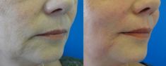 Injekční výplně - fotka před - MUDr. Evžen Trupar Ph.D.