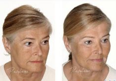 Hyaluronic acid-based wrinkle fillers - Photo before - Dr. Dobos Calin