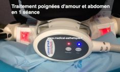 Cryolipolyse - Cliché avant - Dr AMAT - ????Greffe FUE 2.0 Medic Xpert