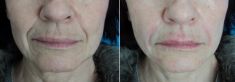 Injekční výplně - fotka před - MUDr. Evžen Trupar Ph.D.
