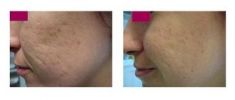 Scar removal - Photo before - Klinika Laser Esthetic