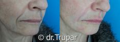 Injekční výplně - fotka před - MUDr. Evžen Trupar Ph.D.