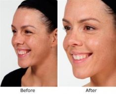 Facelift - Photo before - Dr. Carmen Munteanu