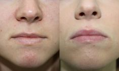 Lip augmentation - cheiloplasty - Photo before - ARS ESTETICA – Klinika Medycyny Estetycznej i Laseroterapii