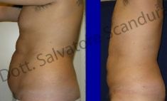 Liposuzione - Foto del prima - Dott. Salvatore Scandura M.D.