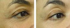 Radiofrequency Rejuvenation (Aluma, accent, TriPollar, Spa RF device, Re-Age) - Photo before - Klinika Laser Esthetic