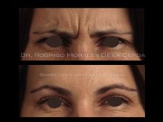 Botulinum toxin - Wrinkle Removal - Photo before - Dr. Rodrigo Morales De la Cerda