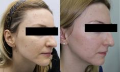 Fractional Laser Resurfacing - Photo before - ARS ESTETICA – Klinika Medycyny Estetycznej i Laseroterapii