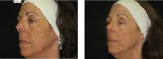 Radiofrequency Rejuvenation (Aluma, accent, TriPollar, Spa RF device, Re-Age) - Photo before - Klinika Laser Esthetic