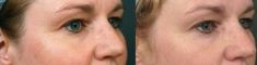 Radiofrequency Rejuvenation (Aluma, accent, TriPollar, Spa RF device, Re-Age) - Photo before - Klinika Laser Esthetic